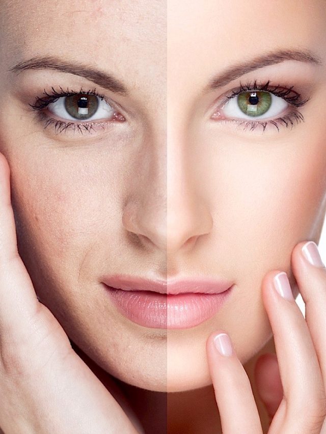 Rejuvenate your skin with the Opus plasma skin resurfacing treatment at Natalie K. Provenzano DDS, Inc.